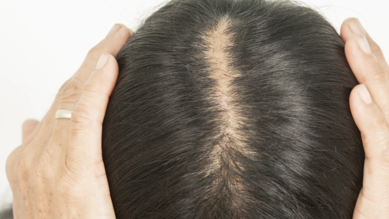 Finding a Female Hair Thinning Specialist in Annapolis, Maryland